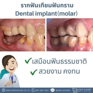 molar implant